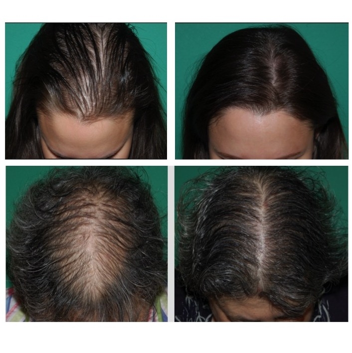 TruVarin Supports Hair Growth Formula